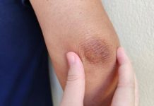 अब काली कोहनी की समस्या नहीं होगी शर्मिंदगी की वजह, बनाएं ये देसी नुस्खा, 3 दिन में लौटेगी नेचुरल चमक