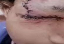 दर्दनाक घटना: स्कूल से घर लौटते समय बच्चे की आँख में घुसी पेंसिल, गंभीर हालत में IGMC रेफर