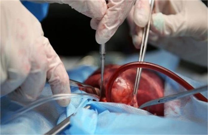 2025_10image_16_10_317989222canadahearttransplant.-ll